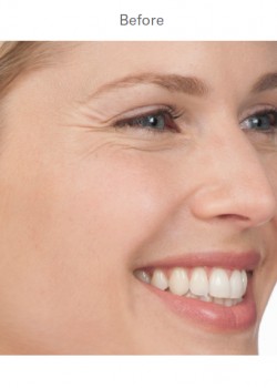 Before Image: Botox – 3 - other