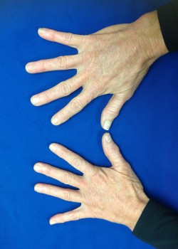 After Image: Radiesse Hands – 17129 - front