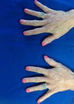 Before Image: Radiesse Hands – 17129 - front