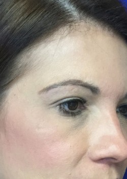 After Image: Restylane L – Tear Trough – 15660 - other