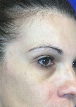 Before Image: Restylane L – Tear Trough – 15660 - other