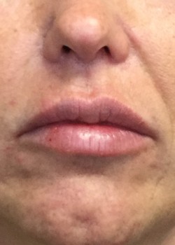After Image: Juvederm Ultra – Lips – 21614 - front