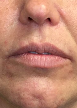 Before Image: Juvederm Ultra – Lips – 21614 - front