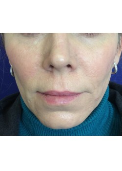 After Image: Juvederm Voluma – 17171 - front