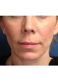 Before Image: Juvederm Voluma – 17171 - front