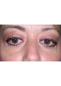 After Image: Restylane  L- Tear Trough -15572 - front