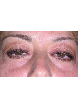 Before Image: Restylane  L- Tear Trough -15572 - front