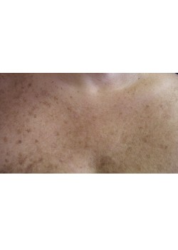After Image: Photofacial (IPL) – Chest – 15572 - front