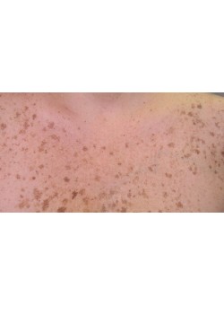 Before Image: Photofacial (IPL) – Chest – 15572 - front