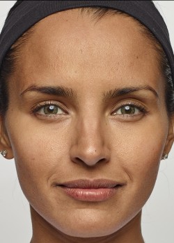 After Image: Dysport – Glabella -1 - front
