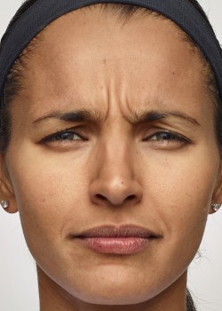 Before Image: Dysport – Glabella -1 - front