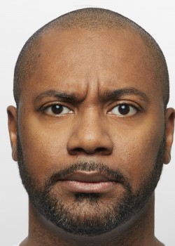 Before Image: Dysport – Glabella – 2 - front