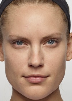 After Image: Dysport – Glabella -3 - front