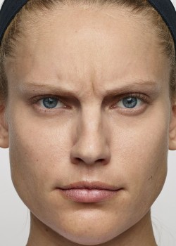 Before Image: Dysport – Glabella -3 - front